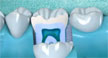 Procedure for root canal